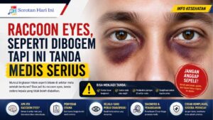 Kenali Raccoon Eyes, Seperti Dibogem tapi Ini Tanda Medis Serius